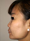 Nose Job NYC