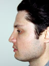 Nose Job NYC