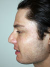 Nose Job NYC