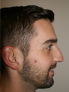 Nose Job NYC