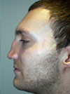 Rhinoplasty in NYC