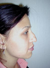 Nose Job New York