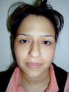 Nose Job New York