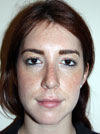 Nose Job New York
