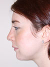 Nose Job New York