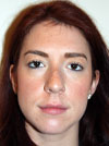 Nose Job New York
