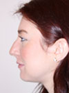 Nose Job New York