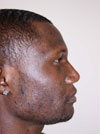 Nose Job New York