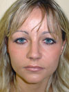 Nose Job NYC