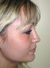 Nose Job NYC
