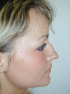 Nose Job NYC