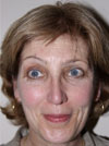 Nose Job NYC