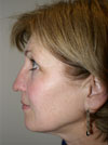 Nose Job NYC