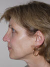 Nose Job NYC