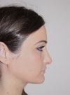 Nose Job NYC