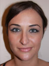 Nose Job NYC