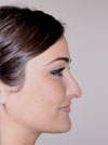 Nose Job NYC