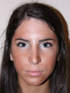 Nose Job New York