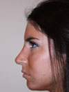 Nose Job New York