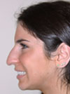 Nose Job New York