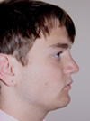 Rhinoplasty in NYC
