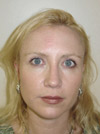 Nose Job NYC