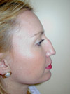 Nose Job NYC