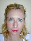 Nose Job NYC
