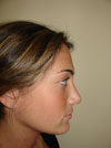 Nose Job New York