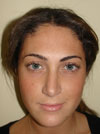Nose Job New York