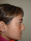 Nose Job New York