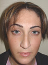 Nose Job New York