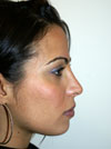 Nose Job New York