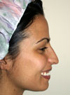 Nose Job New York