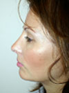 Nose Job New York