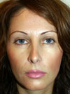 Nose Job New York
