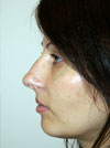 Nose Job New York