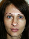 Nose Job New York