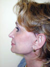 Nose Job New York