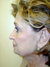 Nose Job New York