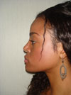 Nose Job New York