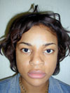 Nose Job New York