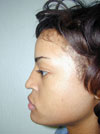 Nose Job New York