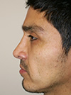 Nose Job NYC