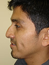 Nose Job NYC
