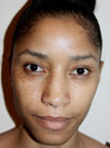 Rhinoplasty in NYC