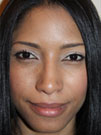 Rhinoplasty in NYC