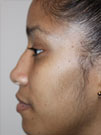 Rhinoplasty in NYC
