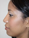 Rhinoplasty in NYC
