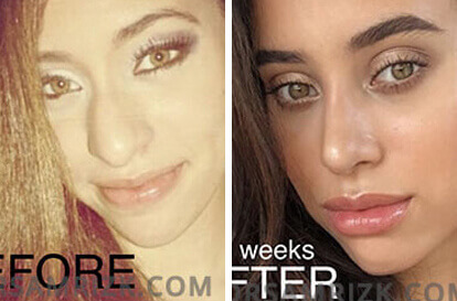 Female face, before and after Rhinoplasty treatment, front view, patient 7